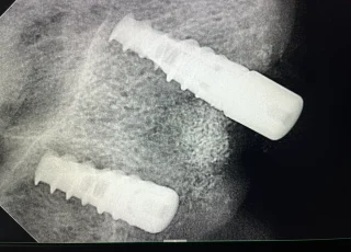 two dental implants narrow ridge xray