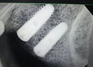 two dental implants posterior lower jaw xray