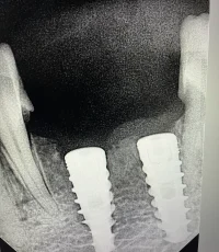 two dental implants upper jaw sinus region xray