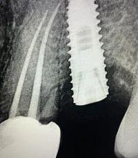 upper front dental implant xray
