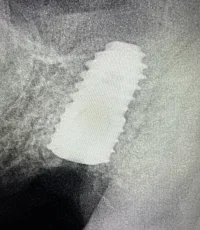 wide diameter dental implant xray
